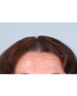 After Hair Transplant&nbsp;Hair Thinning