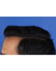 After Hair Transplant&nbsp;Front