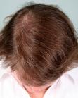 After Hair Transplant&nbsp;Hair Thinning