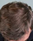 After Hair Transplant&nbsp;Front