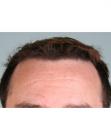 After Hair Transplant &nbsp;Hairlines