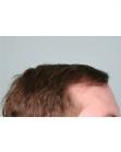 After Hair Transplant&nbsp;Hairlines