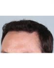 After Hair Transplant&nbsp;Front