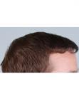 After Hair Transplant&nbsp;Front