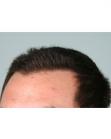 After Hair Transplant&nbsp;Hairlines