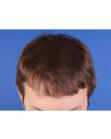 After Hair Transplant&nbsp;Front