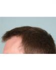 After Hair Transplant&nbsp;Front