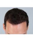 After Hair Transplant &nbsp;Hairlines