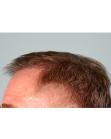 After Hair Transplant&nbsp;Front