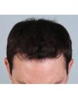 After Hair Transplant&nbsp;Front