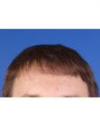 After Hair Transplant  Front