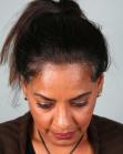 After Hair Transplant &nbsp;Hair Thinning