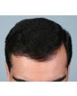 After Hair Transplant&nbsp;Front