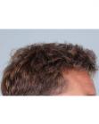 After Hair Transplant&nbsp;Hairlines