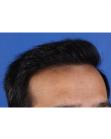 After Hair Transplant&nbsp;Front