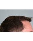 After Hair Transplant&nbsp;Hairlines