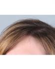 After Hair Transplant&nbsp;Hair Thinning