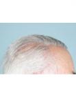 After Hair Transplant&nbsp;Hairlines