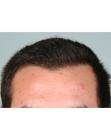 After Hair Transplant &nbsp;Hairlines