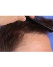 After Hair Transplant&nbsp;Revision