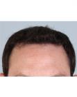 After Hair Transplant &nbsp;Front