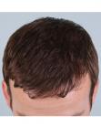 After Hair Transplant &nbsp;Front