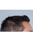 After Hair Transplant&nbsp;Front