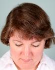 After Hair Transplant&nbsp;Hair Thinning