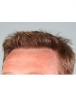 After Hair Transplant&nbsp;Hairlines
