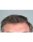 After Hair Transplant&nbsp;Front