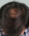 After Hair Transplant&nbsp;2 Sessions (Areas)