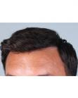 After Hair Transplant&nbsp;Front