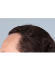 After Hair Transplant&nbsp;Temporal Hairline