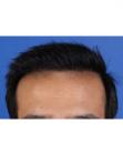 After Hair Transplant &nbsp;Front
