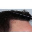 After Hair Transplant&nbsp;Front