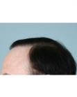 After Hair Transplant&nbsp;Revision