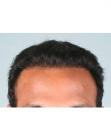 After Hair Transplant &nbsp;Hairlines