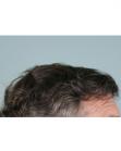 After Hair Transplant &nbsp;Front