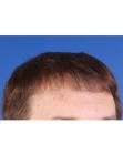 After Hair Transplant&nbsp;Front