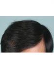 After Hair Transplant&nbsp;2 Sessions (Areas)