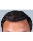 After Hair Transplant &nbsp;Front