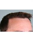 After Hair Transplant&nbsp;Hairlines