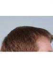 After Hair Transplant&nbsp;Hairlines