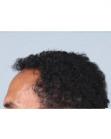 After Hair Transplant&nbsp;Hairlines