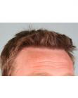 After Hair Transplant&nbsp;Hairlines