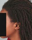 After Hair Transplant&nbsp;Traction Alopecia