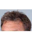 After Hair Transplant&nbsp;Hairlines