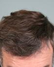 After Hair Transplant&nbsp;Front