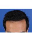 After Hair Transplant&nbsp;Front