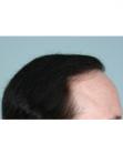 After Hair Transplant&nbsp;Revision